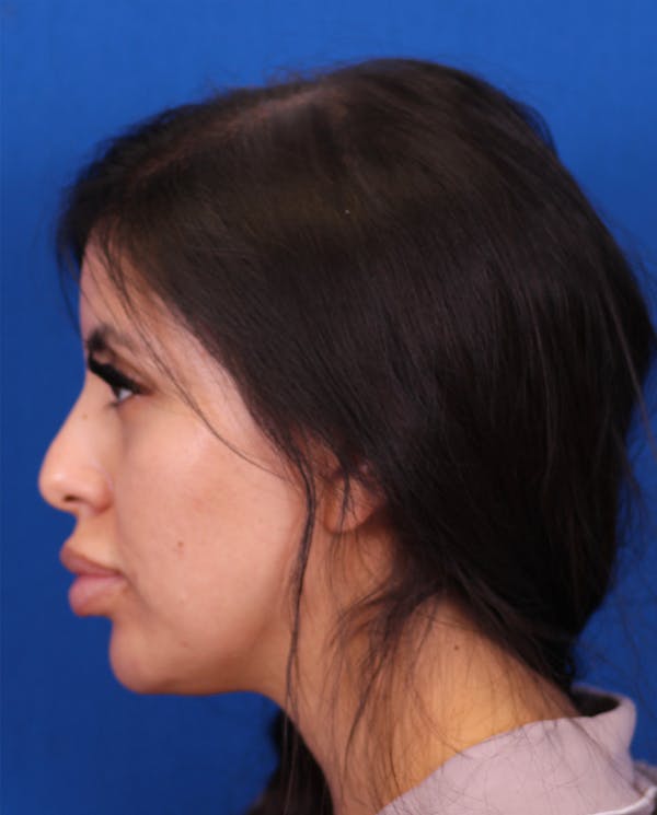 Rhinoplasty Before & After Gallery - Patient 148703158 - Image 1