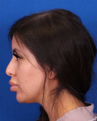 Rhinoplasty Before & After Gallery - Patient 148703158 - Image 1