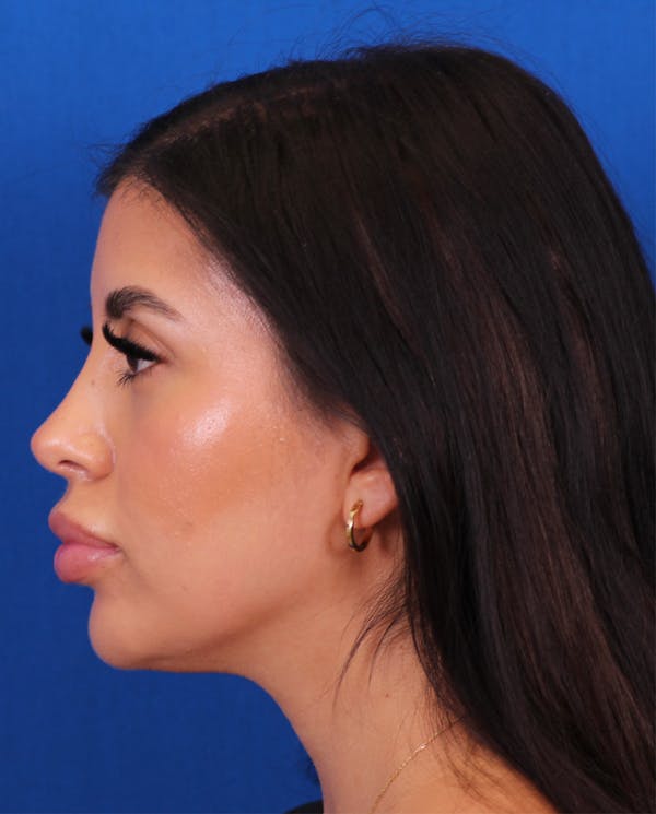 Rhinoplasty Before & After Gallery - Patient 148703158 - Image 2