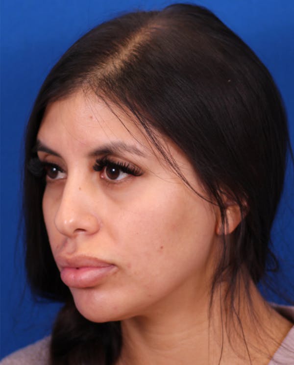 Rhinoplasty Before & After Gallery - Patient 148703158 - Image 3