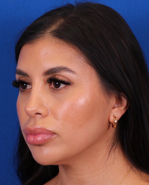 Rhinoplasty Before & After Gallery - Patient 148703158 - Image 4
