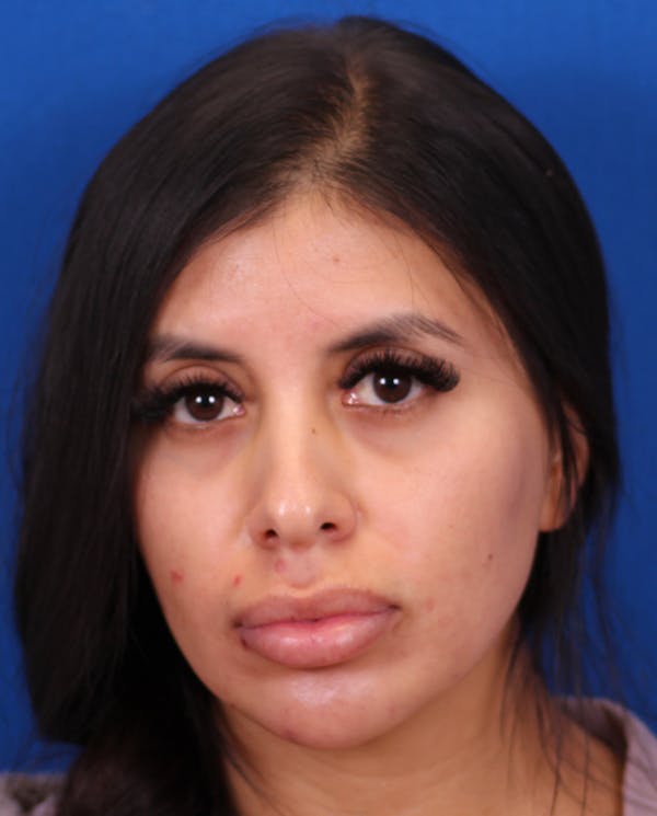 Rhinoplasty Before & After Gallery - Patient 148703158 - Image 5