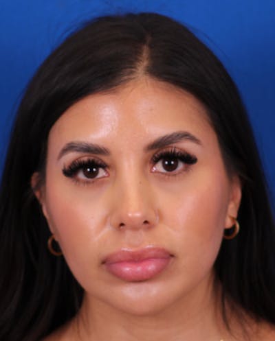 Rhinoplasty Before & After Gallery - Patient 148703158 - Image 6