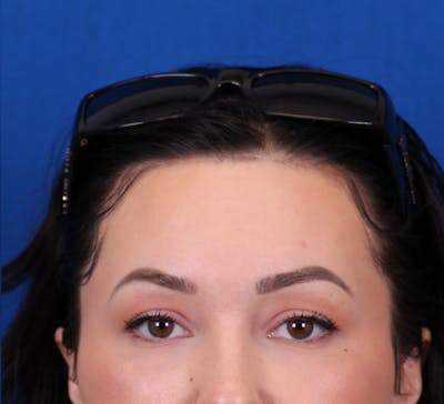Brow Lift Before & After Gallery - Patient 148703123 - Image 2
