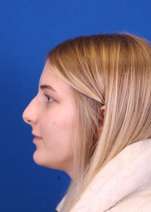 Rhinoplasty Before & After Gallery - Patient 146210133 - Image 1