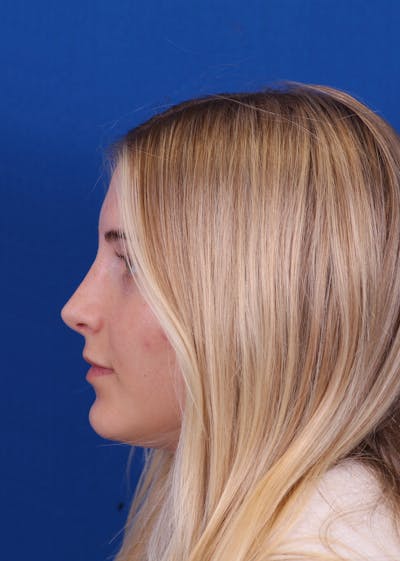 Rhinoplasty Before & After Gallery - Patient 146210133 - Image 2