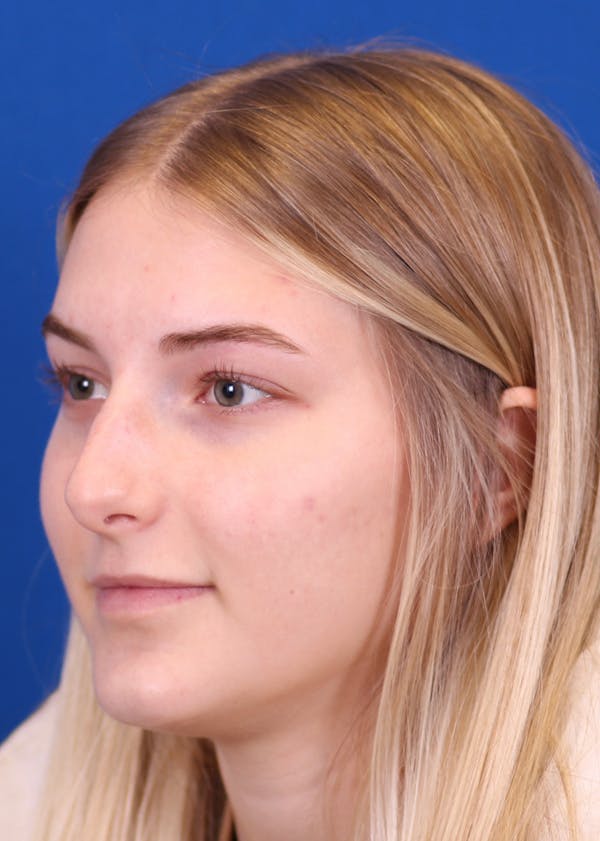 Rhinoplasty Before & After Gallery - Patient 146210133 - Image 3