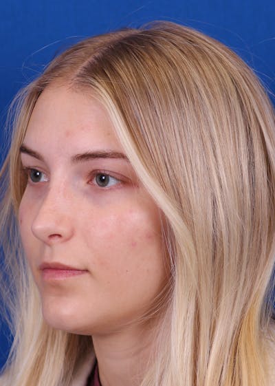 Rhinoplasty Before & After Gallery - Patient 146210133 - Image 4