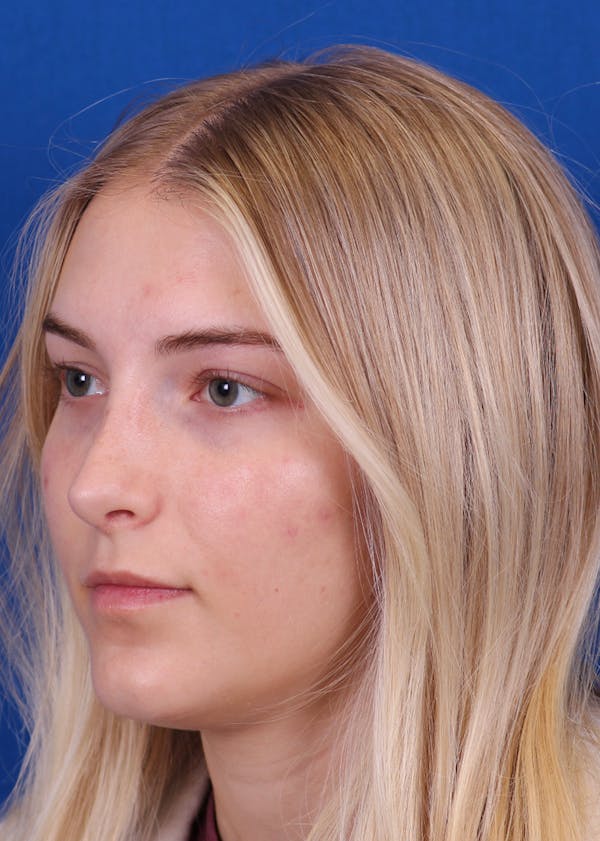 Rhinoplasty Before & After Gallery - Patient 146210133 - Image 4