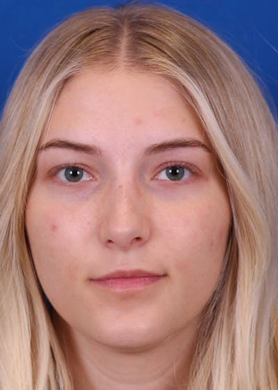 Rhinoplasty Before & After Gallery - Patient 146210133 - Image 6