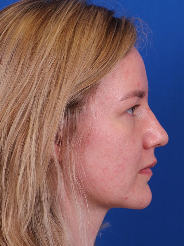 Rhinoplasty Before & After Gallery - Patient 153154233 - Image 1