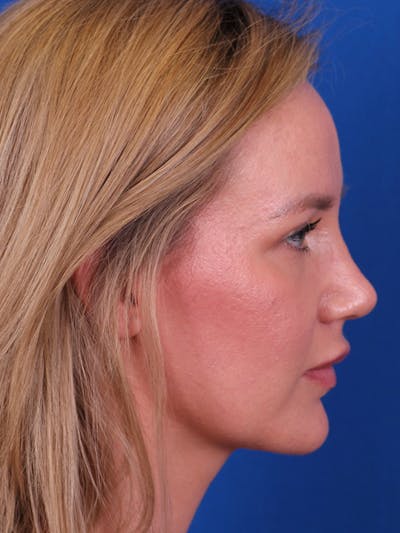 Rhinoplasty Before & After Gallery - Patient 153154233 - Image 2