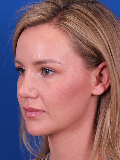 Rhinoplasty Before & After Gallery - Patient 153154233 - Image 4
