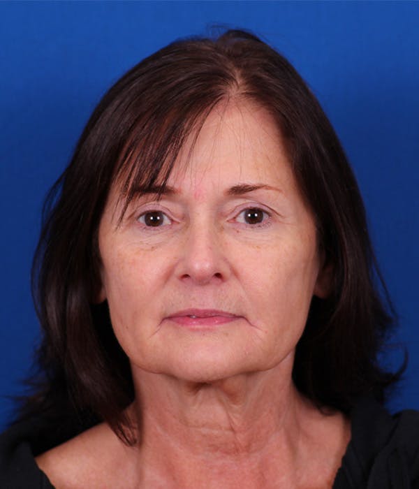 Facelift/Neck Lift Before & After Gallery - Patient 155012404 - Image 1
