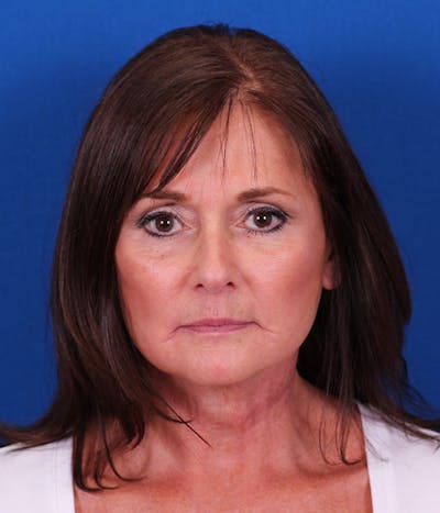 Facelift/Neck Lift Before & After Gallery - Patient 155012404 - Image 2