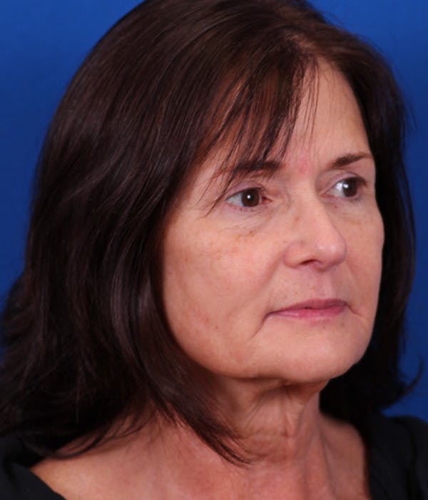 Facelift/Neck Lift Before & After Gallery - Patient 155012404 - Image 3
