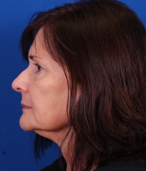 Facelift/Neck Lift Before & After Gallery - Patient 155012404 - Image 5