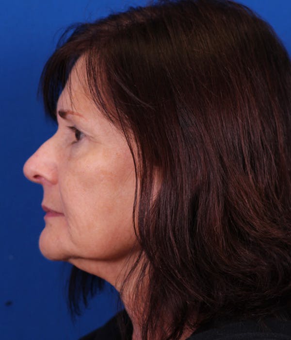 Facelift/Neck Lift Before & After Gallery - Patient 155012404 - Image 5