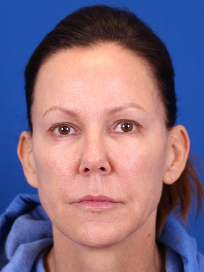 Facelift/Neck Lift Before & After Gallery - Patient 157699502 - Image 1