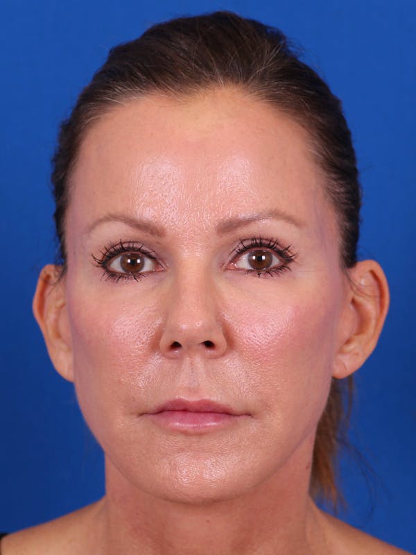 Facelift/Neck Lift Before & After Gallery - Patient 157699502 - Image 2
