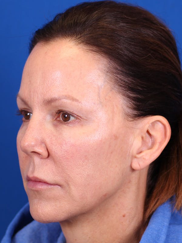 Facelift/Neck Lift Before & After Gallery - Patient 157699502 - Image 3