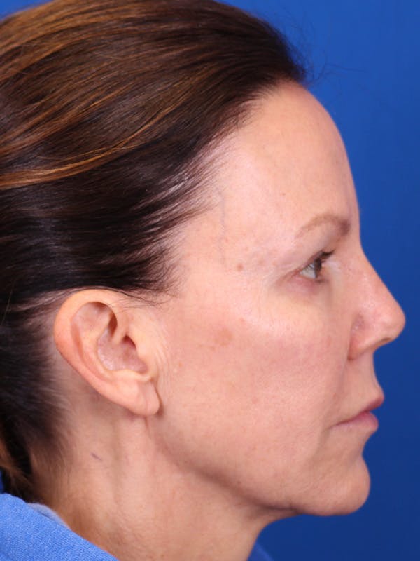 Facelift/Neck Lift Before & After Gallery - Patient 157699502 - Image 5