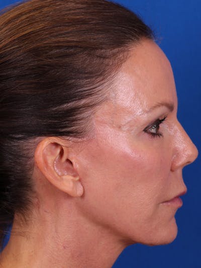 Facelift/Neck Lift Before & After Gallery - Patient 157699502 - Image 6
