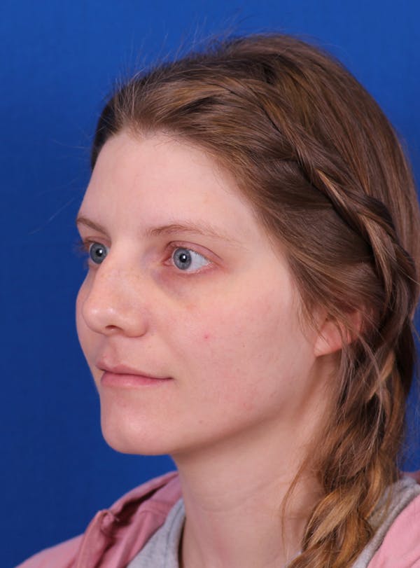Rhinoplasty Before & After Gallery - Patient 169740483 - Image 5