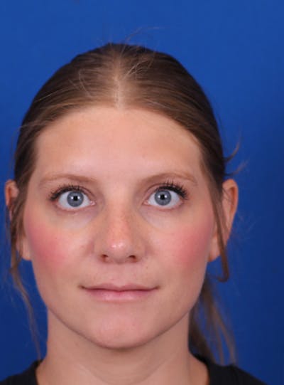 Rhinoplasty Before & After Gallery - Patient 169740483 - Image 4