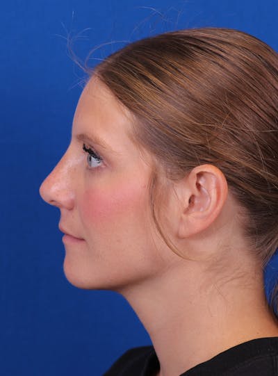 Rhinoplasty Before & After Gallery - Patient 169740483 - Image 2