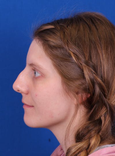 Rhinoplasty Before & After Gallery - Patient 169740483 - Image 1