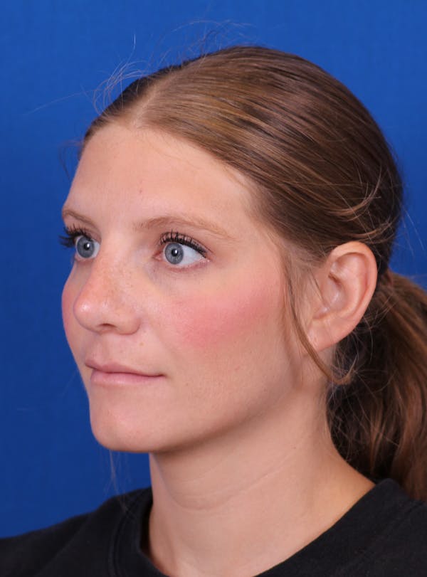 Rhinoplasty Before & After Gallery - Patient 169740483 - Image 6
