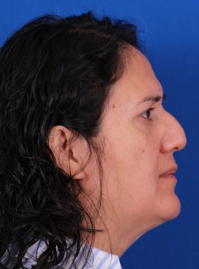 Rhinoplasty Before & After Gallery - Patient 169740482 - Image 1