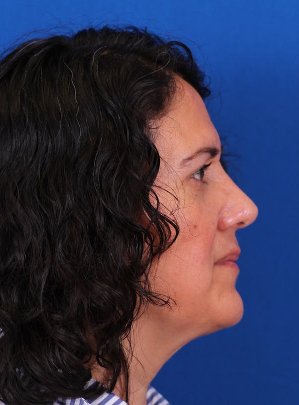 Rhinoplasty Before & After Gallery - Patient 169740482 - Image 2