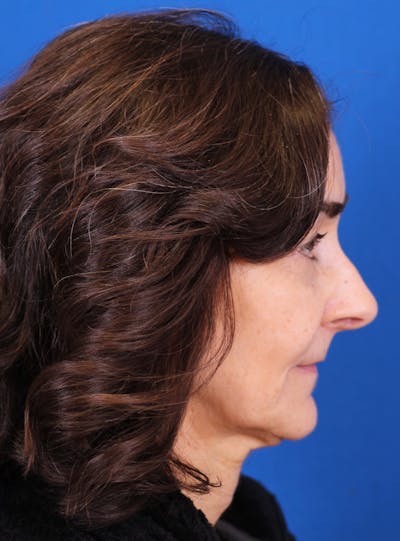 Rhinoplasty Before & After Gallery - Patient 169740521 - Image 1