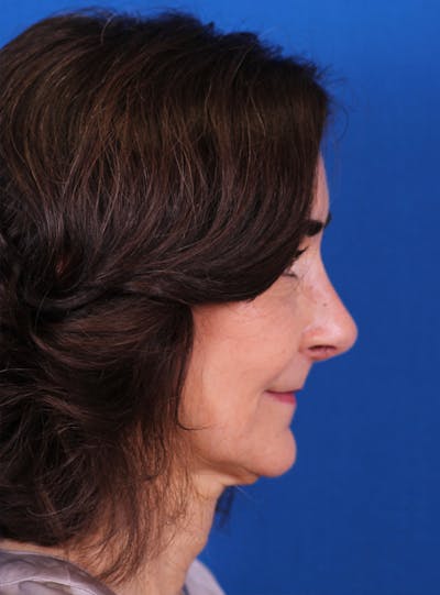 Rhinoplasty Before & After Gallery - Patient 169740521 - Image 2
