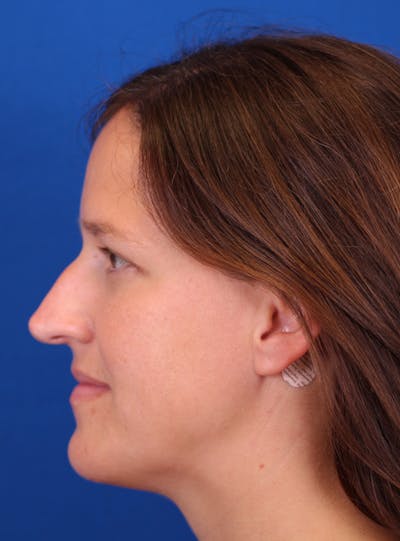 Rhinoplasty Before & After Gallery - Patient 169740520 - Image 1