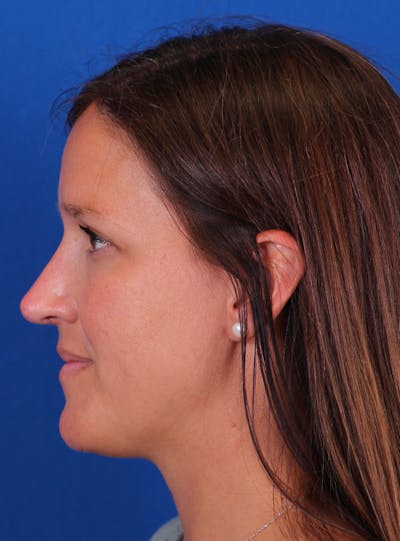 Rhinoplasty Before & After Gallery - Patient 169740520 - Image 2