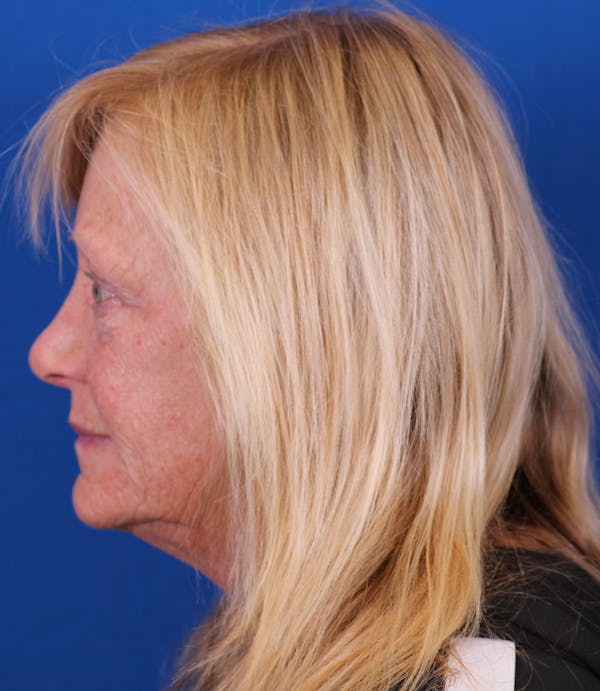 Facelift/Neck Lift Before & After Gallery - Patient 177616345 - Image 5