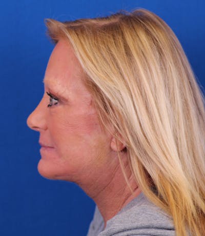 Facelift/Neck Lift Before & After Gallery - Patient 177616345 - Image 6