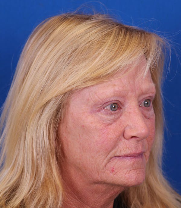 Laser Resurfacing Before & After Gallery - Patient 177883901 - Image 3