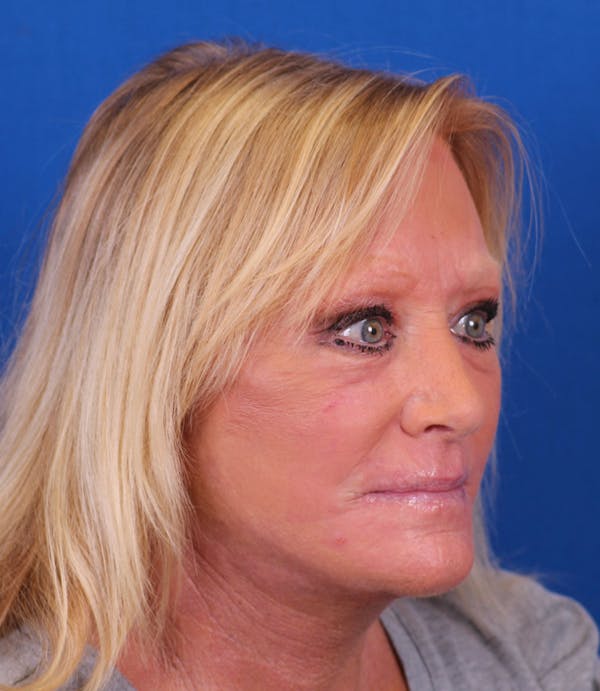 Facelift/Neck Lift Before & After Gallery - Patient 177616345 - Image 4