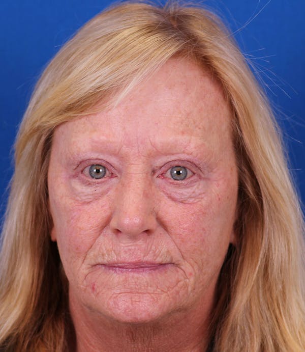 Laser Resurfacing Before & After Gallery - Patient 177883901 - Image 1