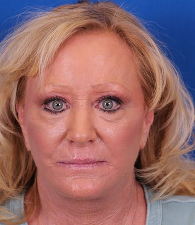 Facelift/Neck Lift Before & After Gallery - Patient 177616345 - Image 2