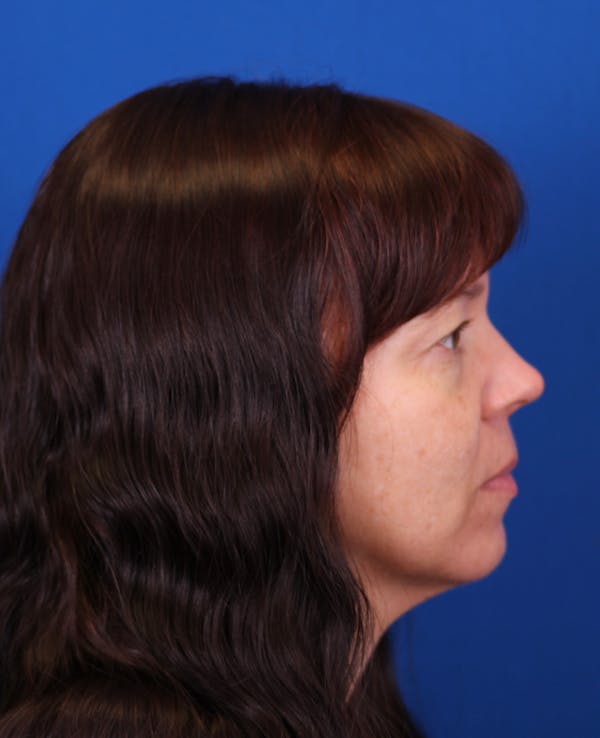 Facelift/Neck Lift Before & After Gallery - Patient 121544171 - Image 5