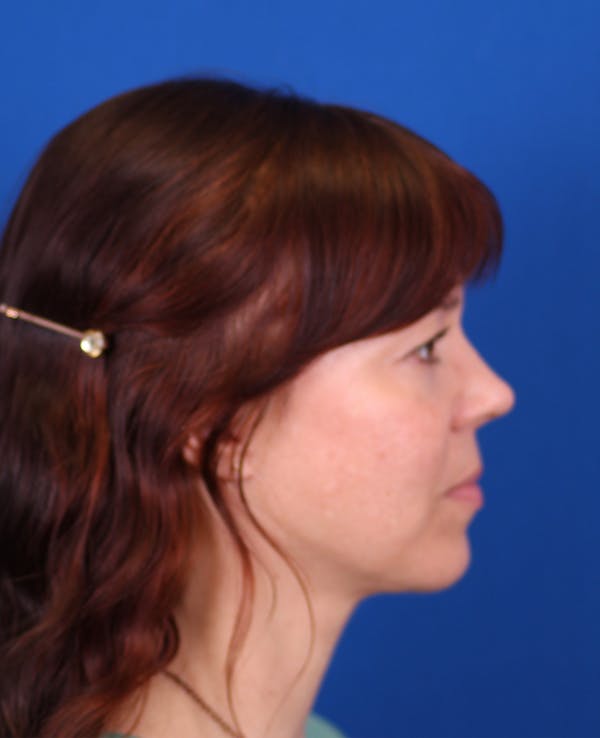 Facelift/Neck Lift Before & After Gallery - Patient 121544171 - Image 6