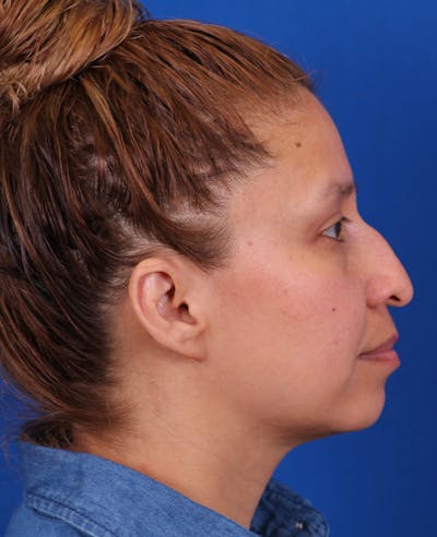Rhinoplasty Before & After Gallery - Patient 160605 - Image 1