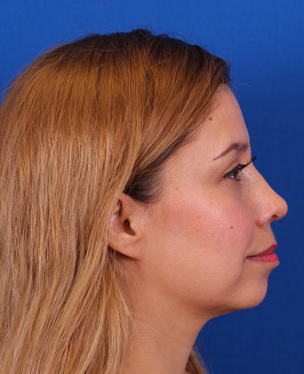 Rhinoplasty Before & After Gallery - Patient 160605 - Image 2