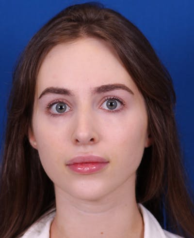 Rhinoplasty Before & After Gallery - Patient 217071 - Image 4