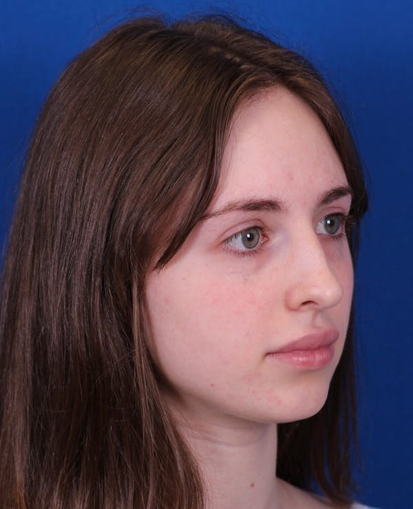 Rhinoplasty Before & After Gallery - Patient 217071 - Image 5